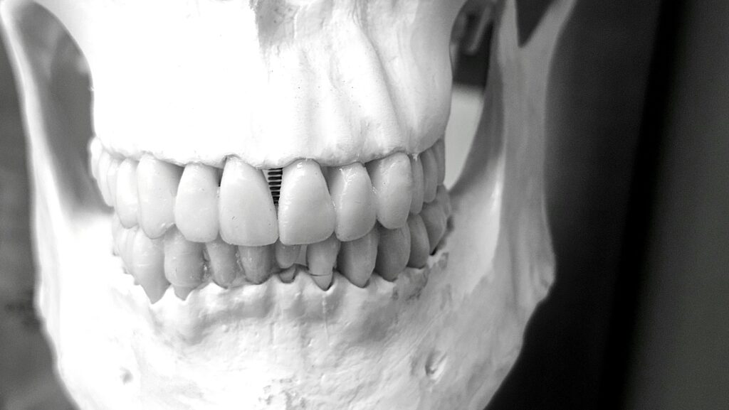 Detailed image of a human skull showcasing dental structure and alignment in a medical context.